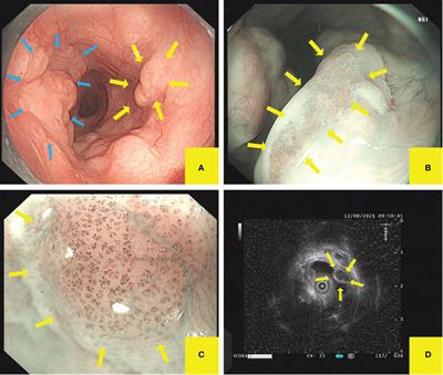 Esophageal low-grade intraepithelial neoplasia overlying multiple leiomyomas: A case report and review of the literature